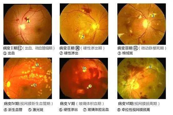 猜测视网膜病变脉压优于紧缩压_视网膜_脉压 智能 猜测视网膜病变脉压优于紧缩压_视网膜_脉压 猜测视网膜病变脉压优于紧缩压_视网膜_脉压 智能